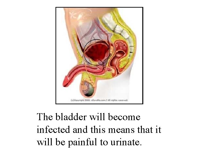 The bladder will become infected and this means that it will be painful to