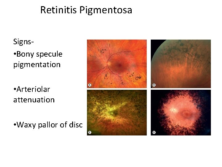 Retinitis Pigmentosa Signs • Bony specule pigmentation • Arteriolar attenuation • Waxy pallor of