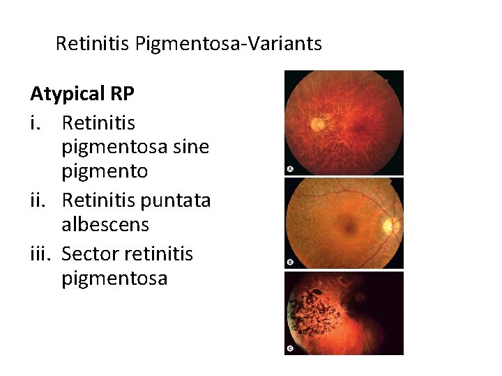 Retinitis Pigmentosa-Variants Atypical RP i. Retinitis pigmentosa sine pigmento ii. Retinitis puntata albescens iii.