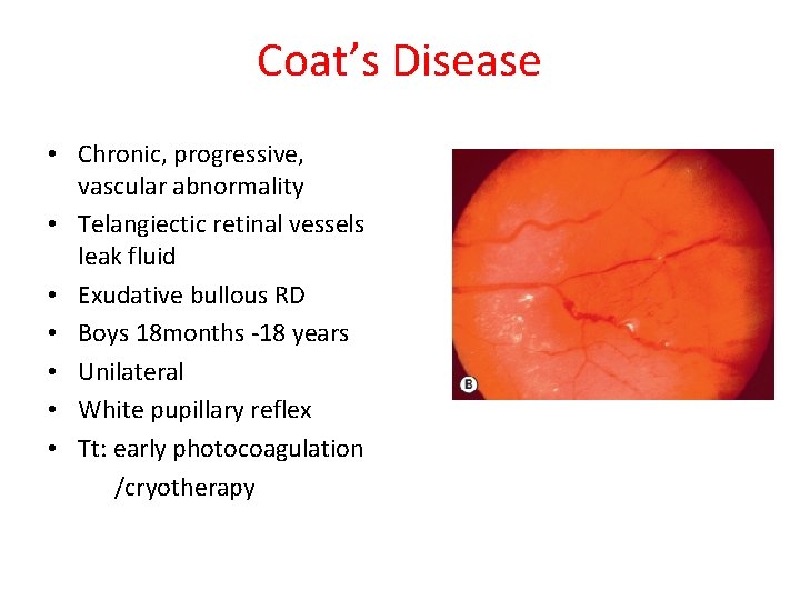 Coat’s Disease • Chronic, progressive, vascular abnormality • Telangiectic retinal vessels leak fluid •