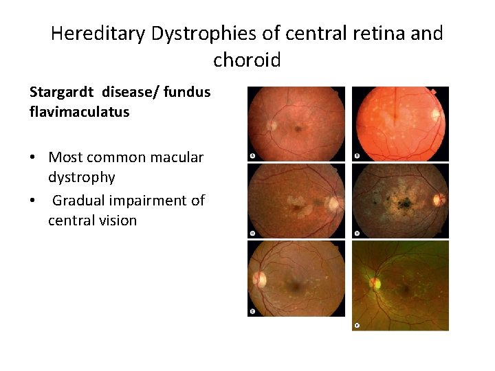 Hereditary Dystrophies of central retina and choroid Stargardt disease/ fundus flavimaculatus • Most common macular