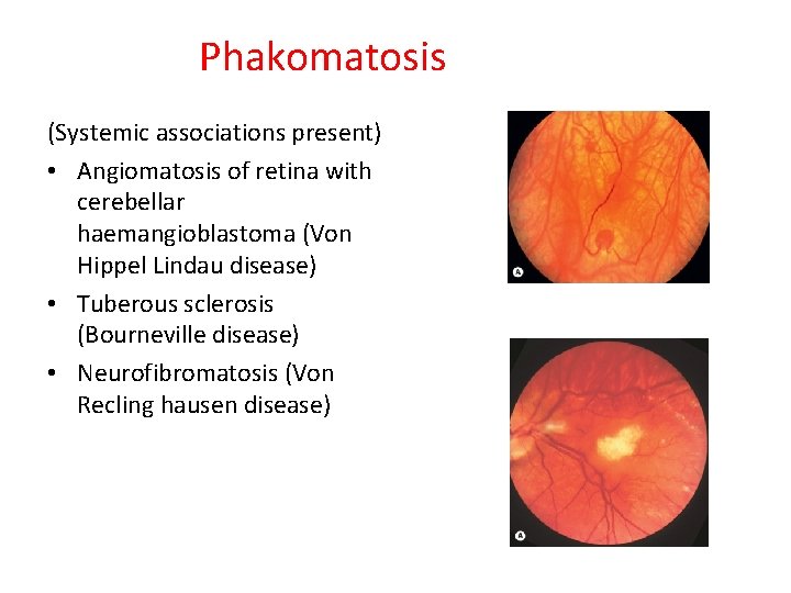 Phakomatosis (Systemic associations present) • Angiomatosis of retina with cerebellar haemangioblastoma (Von Hippel Lindau