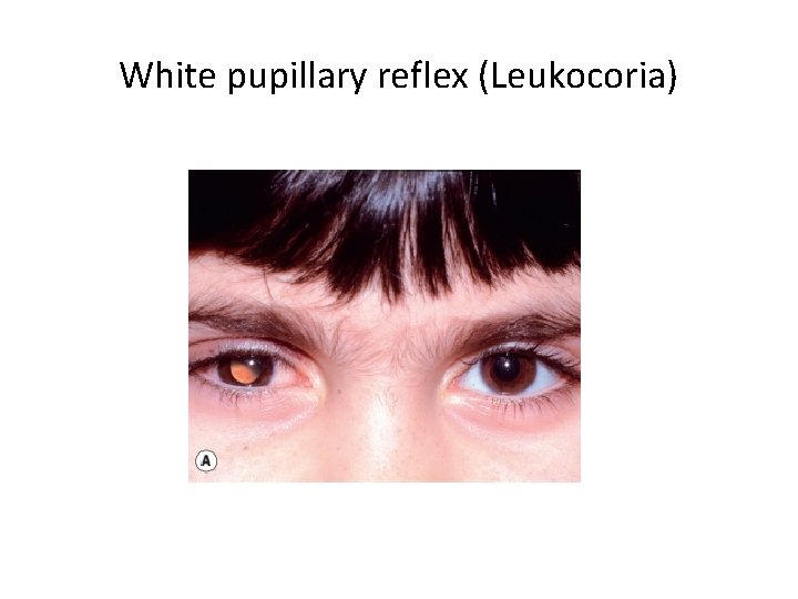 White pupillary reflex (Leukocoria) 