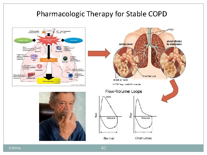 Pharmacologic Therapy for Stable COPD Asthma 40 