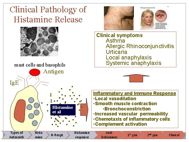 Clinical Pathology of Histamine Release Clinical symptoms Asthma Allergic Rhinoconjunctivitis Urticaria Local anaphylaxis Systemic