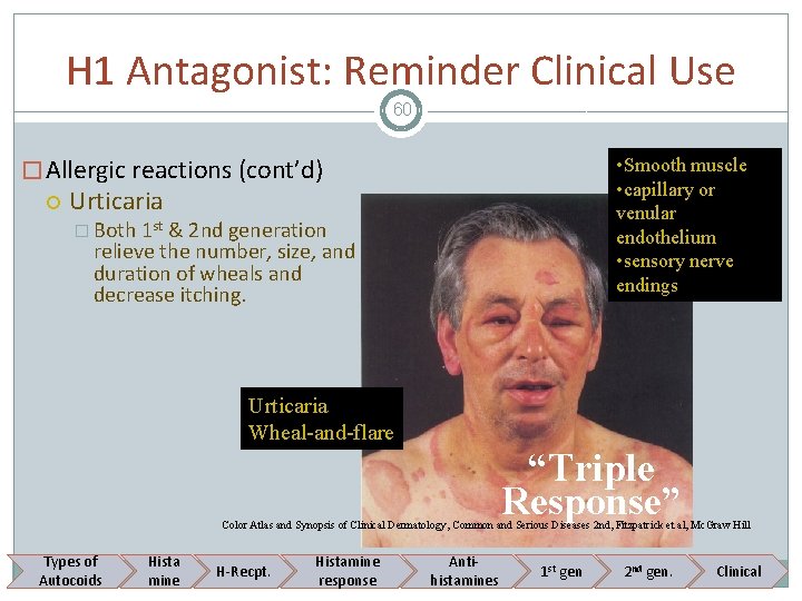 H 1 Antagonist: Reminder Clinical Use 60 � Allergic reactions (cont’d) • Smooth muscle