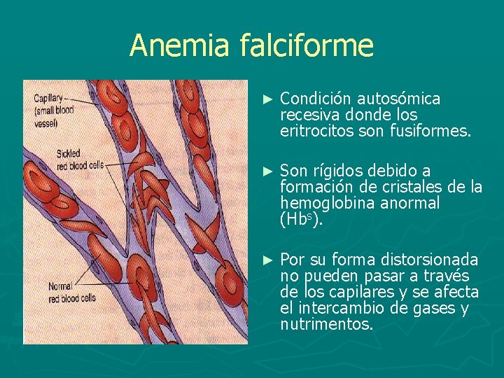 Anemia falciforme ► Condición autosómica recesiva donde los eritrocitos son fusiformes. ► Son rígidos