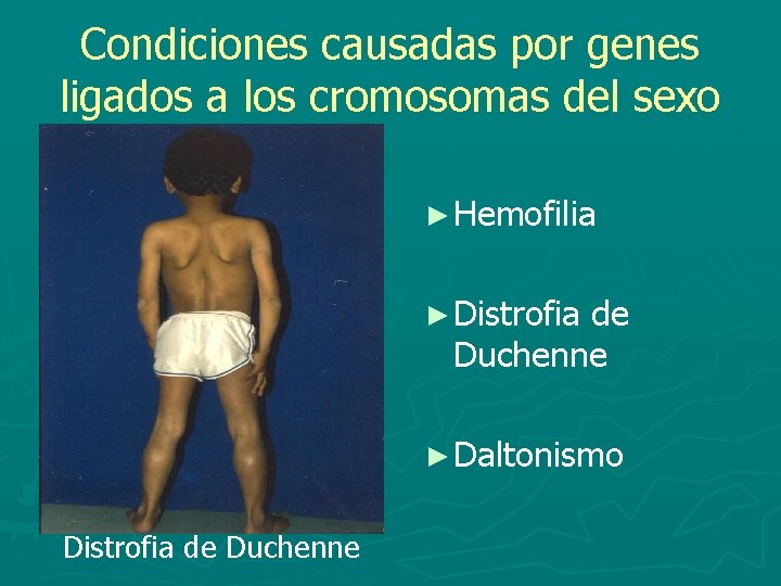 Condiciones causadas por genes ligados a los cromosomas del sexo ► Hemofilia ► Distrofia