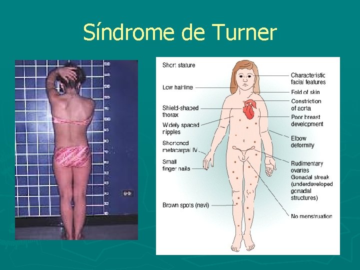 Síndrome de Turner 