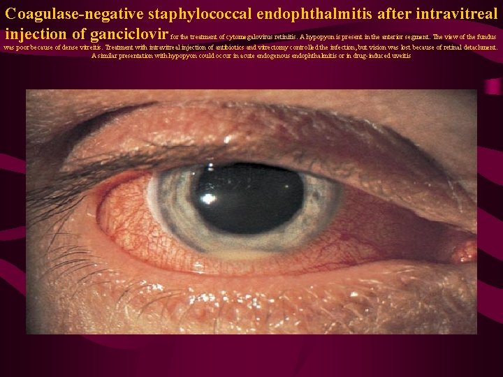 Coagulase-negative staphylococcal endophthalmitis after intravitreal injection of ganciclovir for the treatment of cytomegalovirus retinitis.