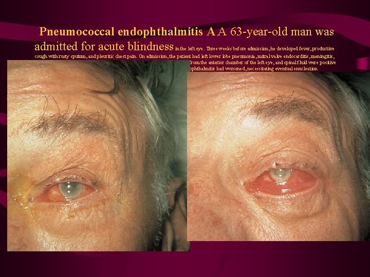  Pneumococcal endophthalmitis A , A 63 -year-old man was admitted for acute blindness