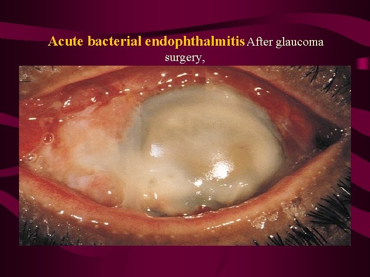 Acute bacterial endophthalmitis After glaucoma surgery, 