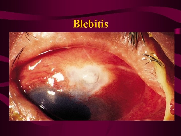 Blebitis 