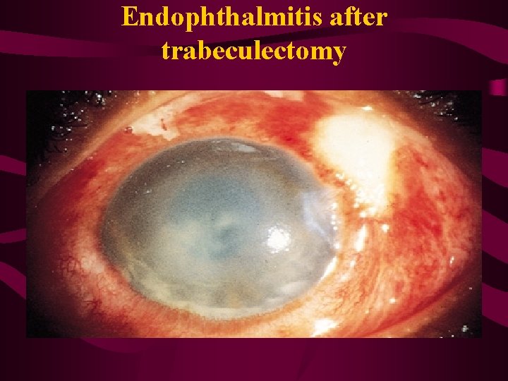 Endophthalmitis after trabeculectomy 