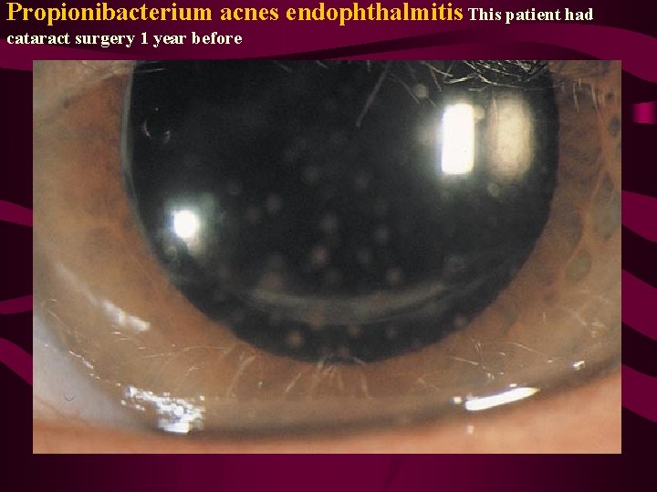 Propionibacterium acnes endophthalmitis This patient had cataract surgery 1 year before 