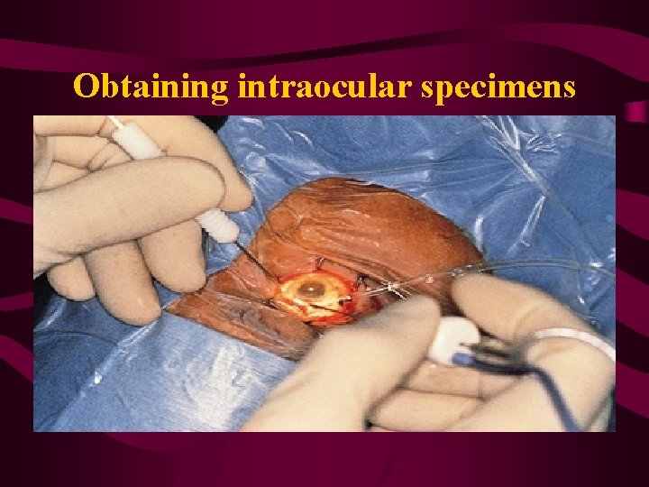 Obtaining intraocular specimens 