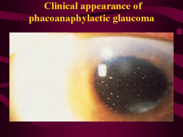  Clinical appearance of phacoanaphylactic glaucoma 