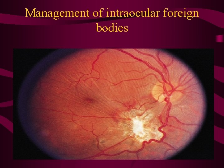 Management of intraocular foreign bodies 