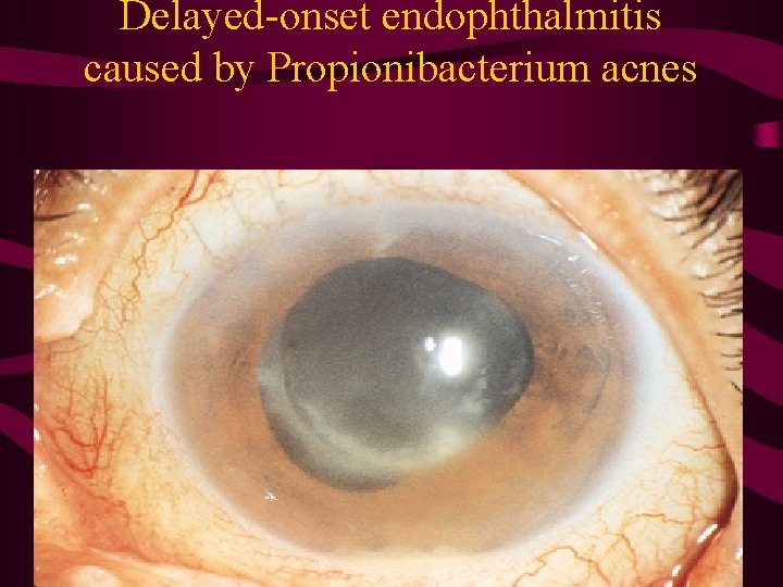 Delayed-onset endophthalmitis caused by Propionibacterium acnes 