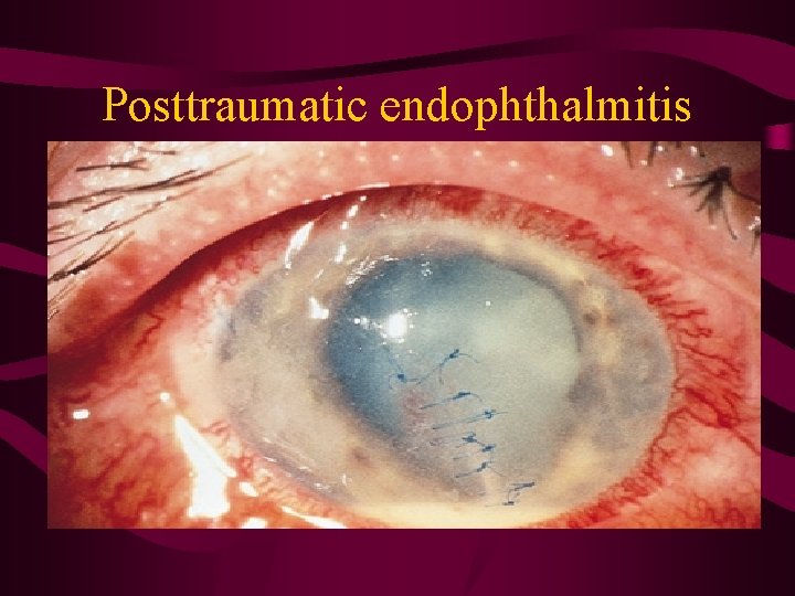 Posttraumatic endophthalmitis 