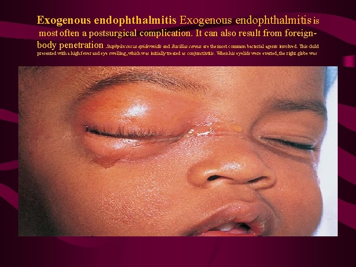 Exogenous endophthalmitis is most often a postsurgical complication. It can also result from foreignbody
