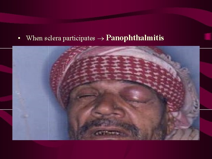  • When sclera participates Panophthalmitis 
