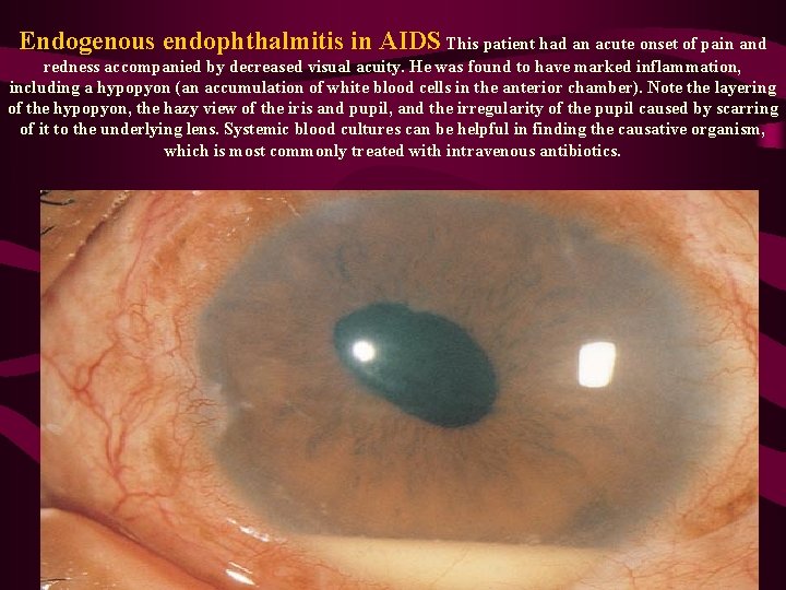 Endogenous endophthalmitis in AIDS This patient had an acute onset of pain and redness