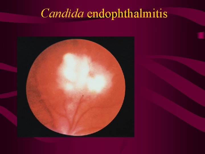 Candida endophthalmitis 