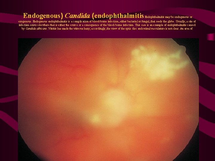 Endogenous) Candida (endophthalmitis Endophthalmitis may be endogenous or exogenous. Endogenous endophthalmitis is a complication