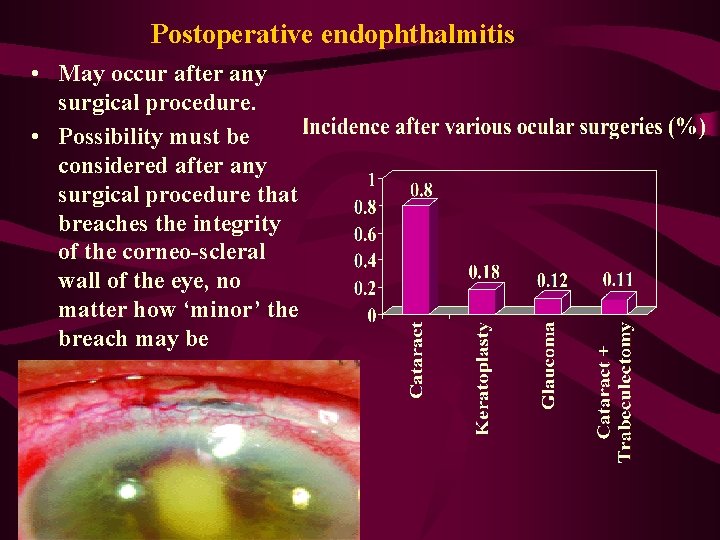 Postoperative endophthalmitis • May occur after any surgical procedure. • Possibility must be considered