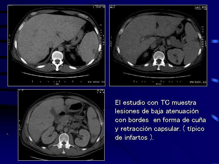 . El estudio con TC muestra lesiones de baja atenuación con bordes en forma