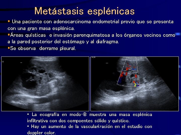 Metástasis esplénicas § Una paciente con adenocarcinoma endometrial previo que se presenta con una