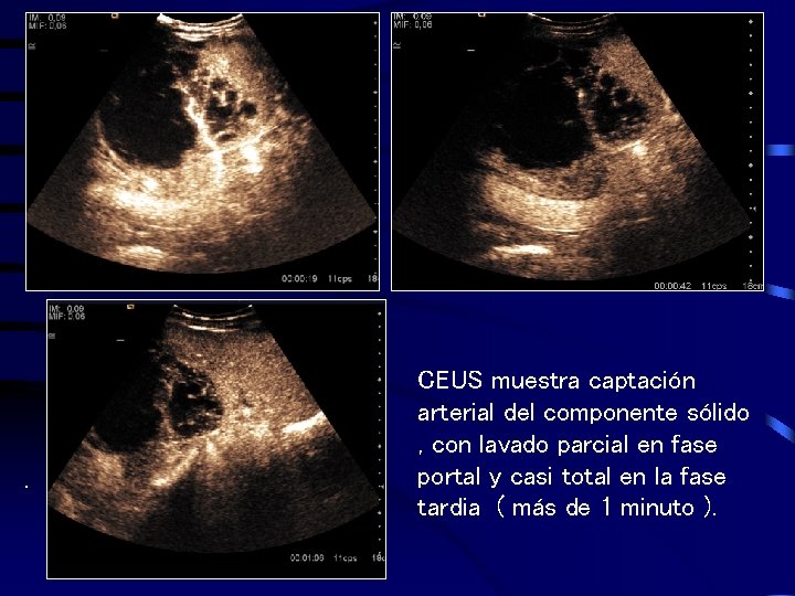 . CEUS muestra captación arterial del componente sólido , con lavado parcial en fase