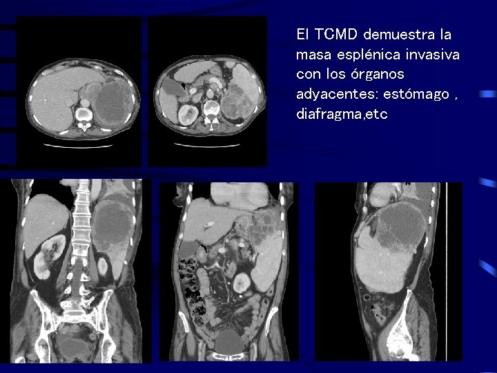 El TCMD demuestra la masa esplénica invasiva con los órganos adyacentes: estómago , diafragma,