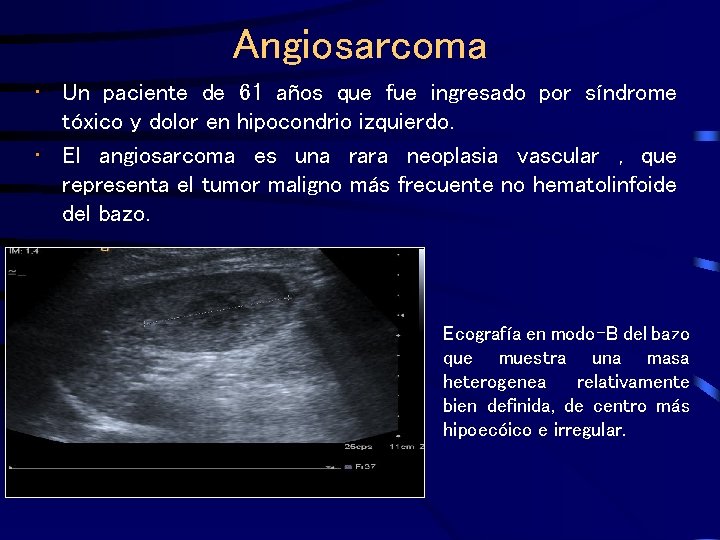 Angiosarcoma • Un paciente de 61 años que fue ingresado por síndrome tóxico y