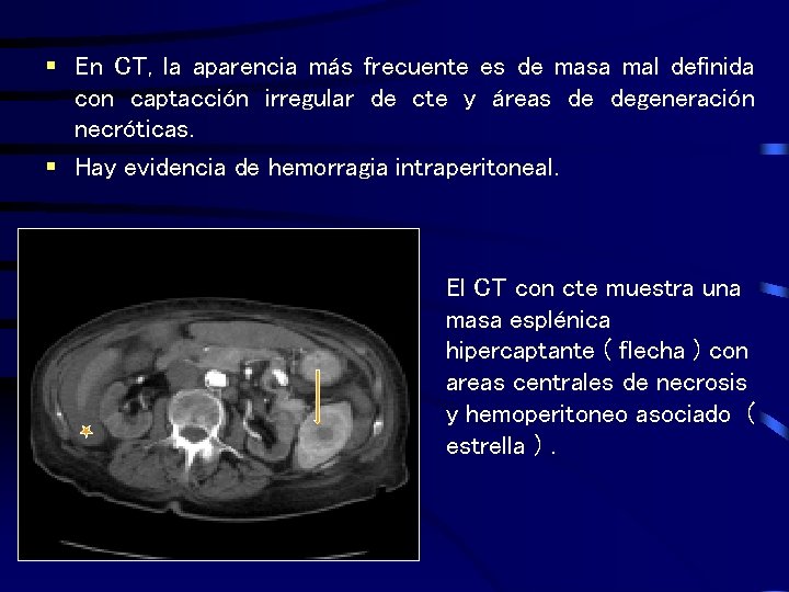 § En CT, la aparencia más frecuente es de masa mal definida con captacción