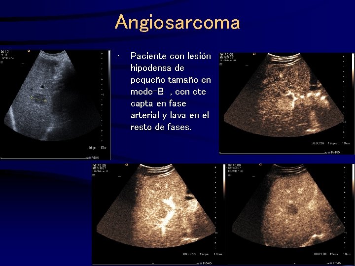 Angiosarcoma • Paciente con lesión hipodensa de pequeño tamaño en modo-B , con cte