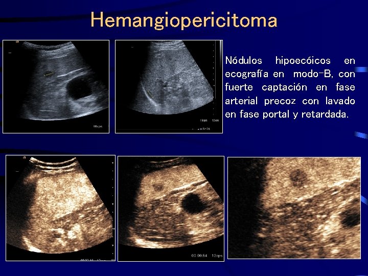 Hemangiopericitoma Nódulos hipoecóicos en ecografía en modo-B, con fuerte captación en fase arterial precoz