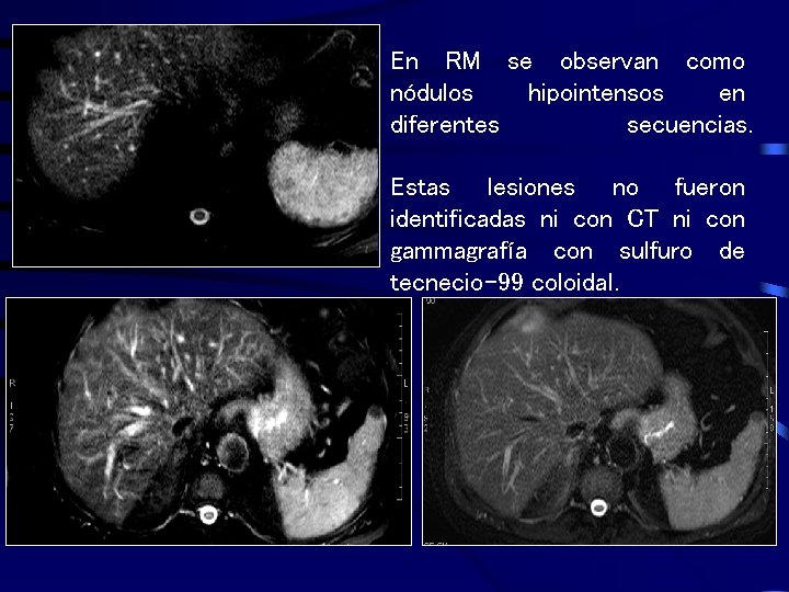 En RM se observan como nódulos hipointensos en diferentes secuencias. Estas lesiones no fueron