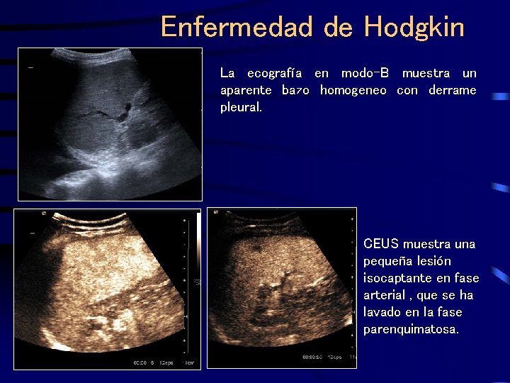 Enfermedad de Hodgkin La ecografía en modo-B muestra un aparente bazo homogeneo con derrame