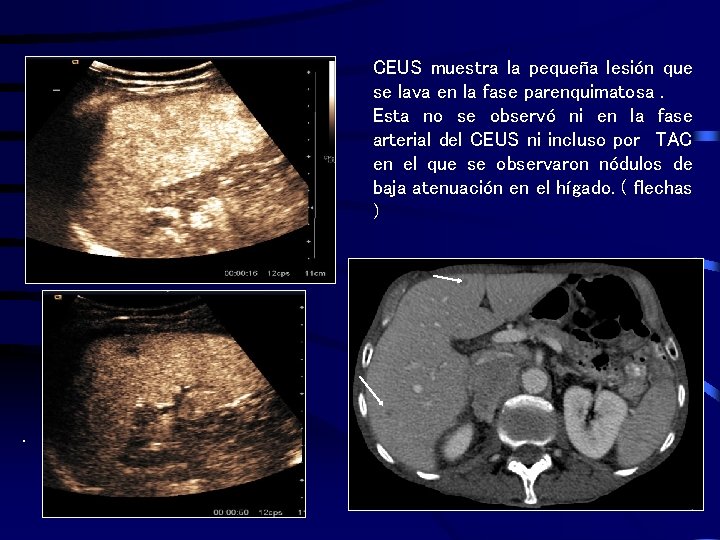 CEUS muestra la pequeña lesión que se lava en la fase parenquimatosa. Esta no