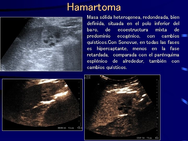 Hamartoma Masa sólida heterogenea, redondeada, bien definida, situada en el polo inferior del bazo,