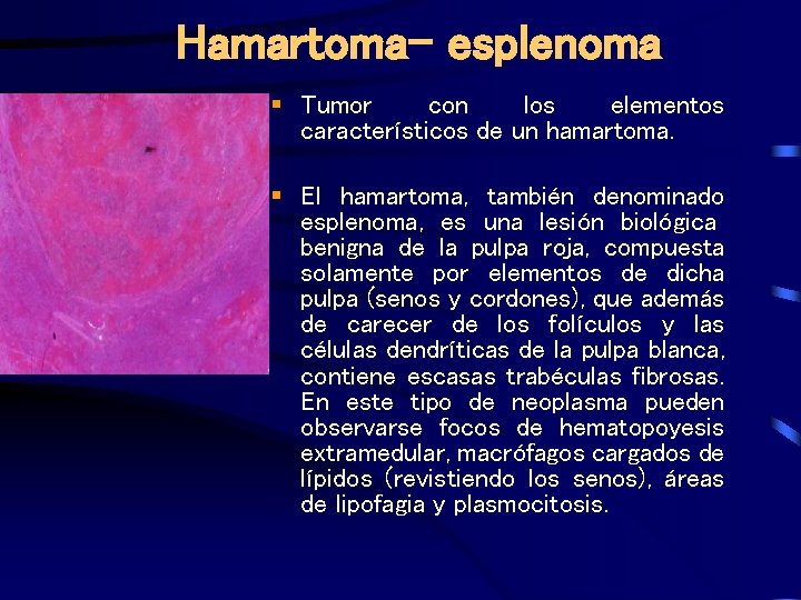 Hamartoma- esplenoma § Tumor con los elementos característicos de un hamartoma. § El hamartoma,