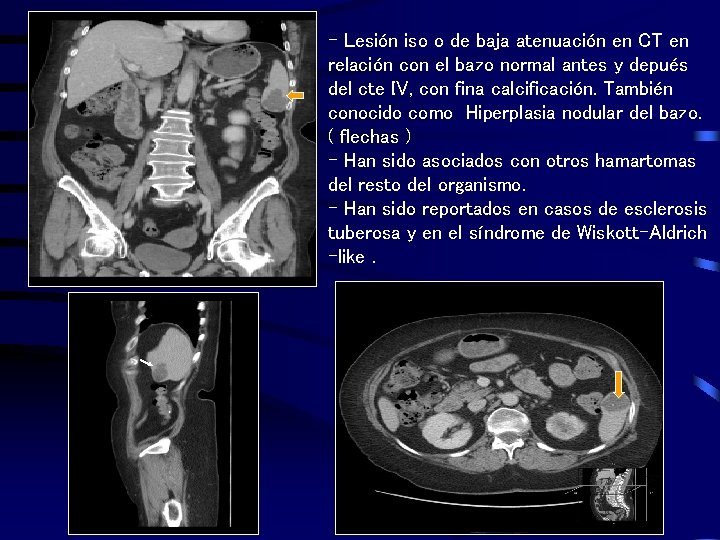 - Lesión iso o de baja atenuación en CT en relación con el bazo