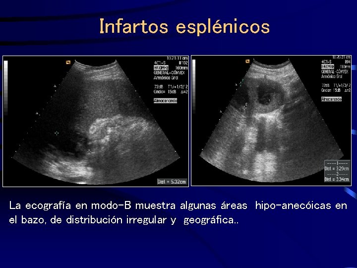 Infartos esplénicos La ecografía en modo-B muestra algunas áreas hipo-anecóicas en. bazo, de distribución