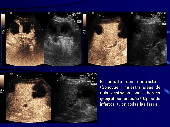 . El estudio contraste (Sonovue ) muestra áreas de nula captación con bordes geográficos