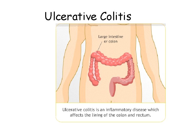 Ulcerative Colitis 