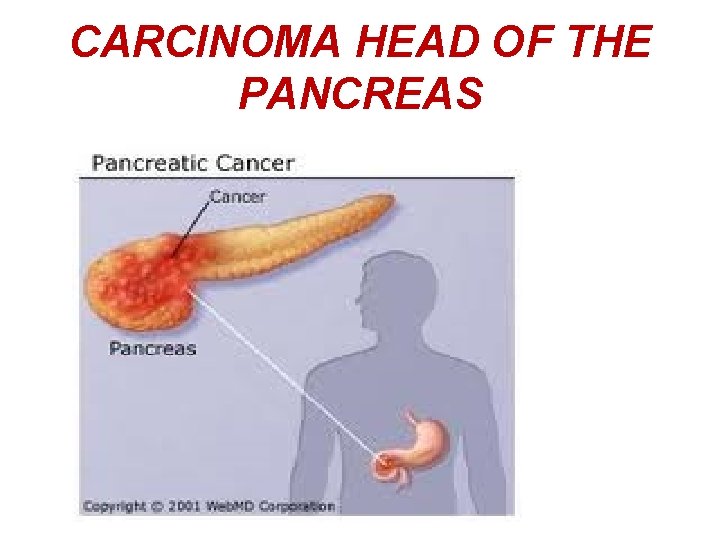 CARCINOMA HEAD OF THE PANCREAS 