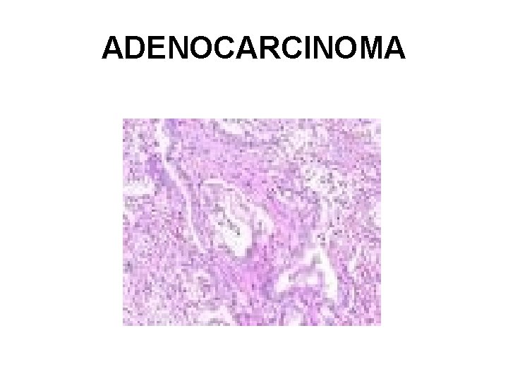 ADENOCARCINOMA 