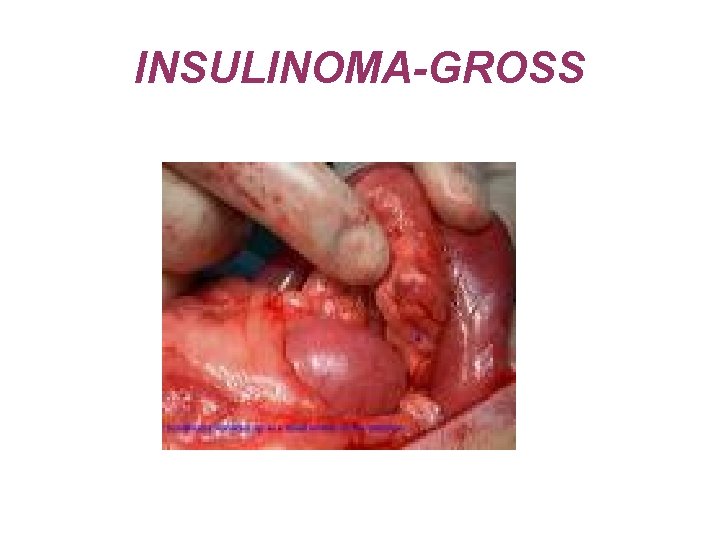 INSULINOMA-GROSS 